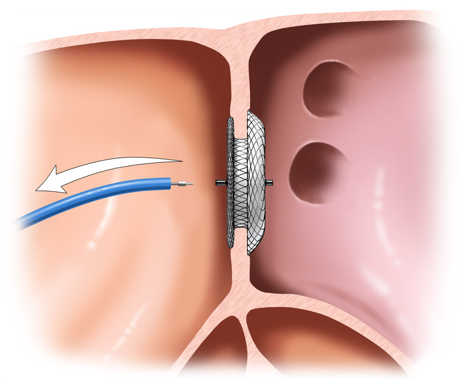 說明: Cable-back